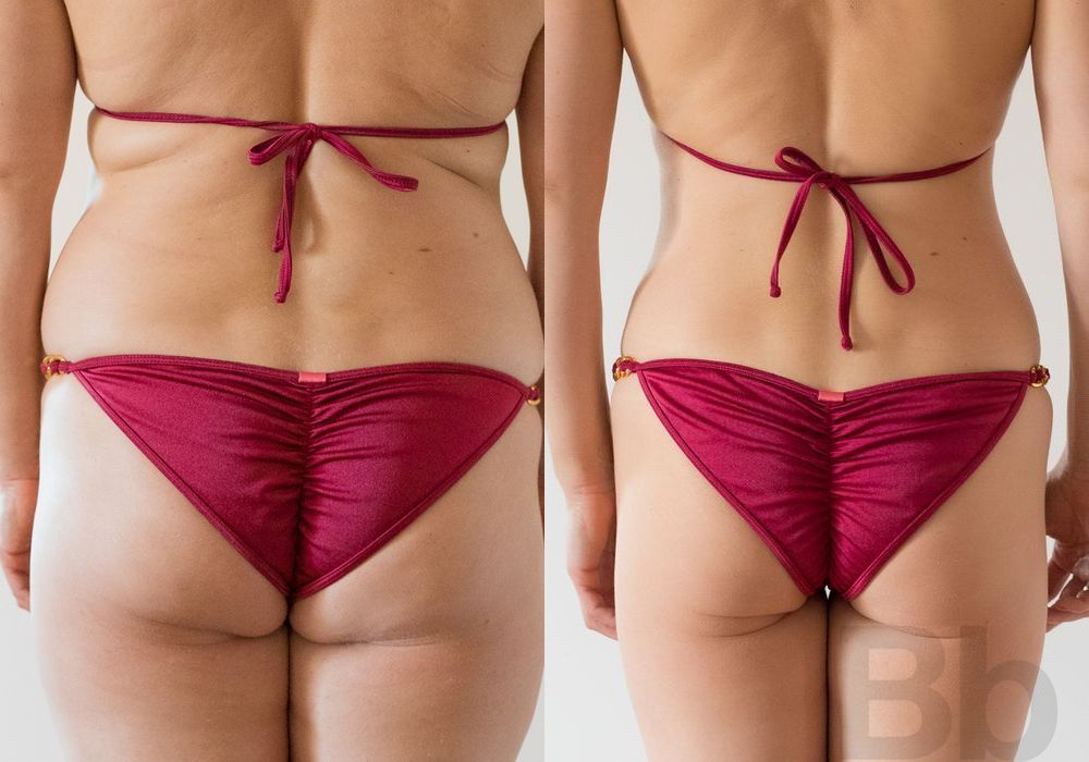 Liposuction - Thumbnail 3