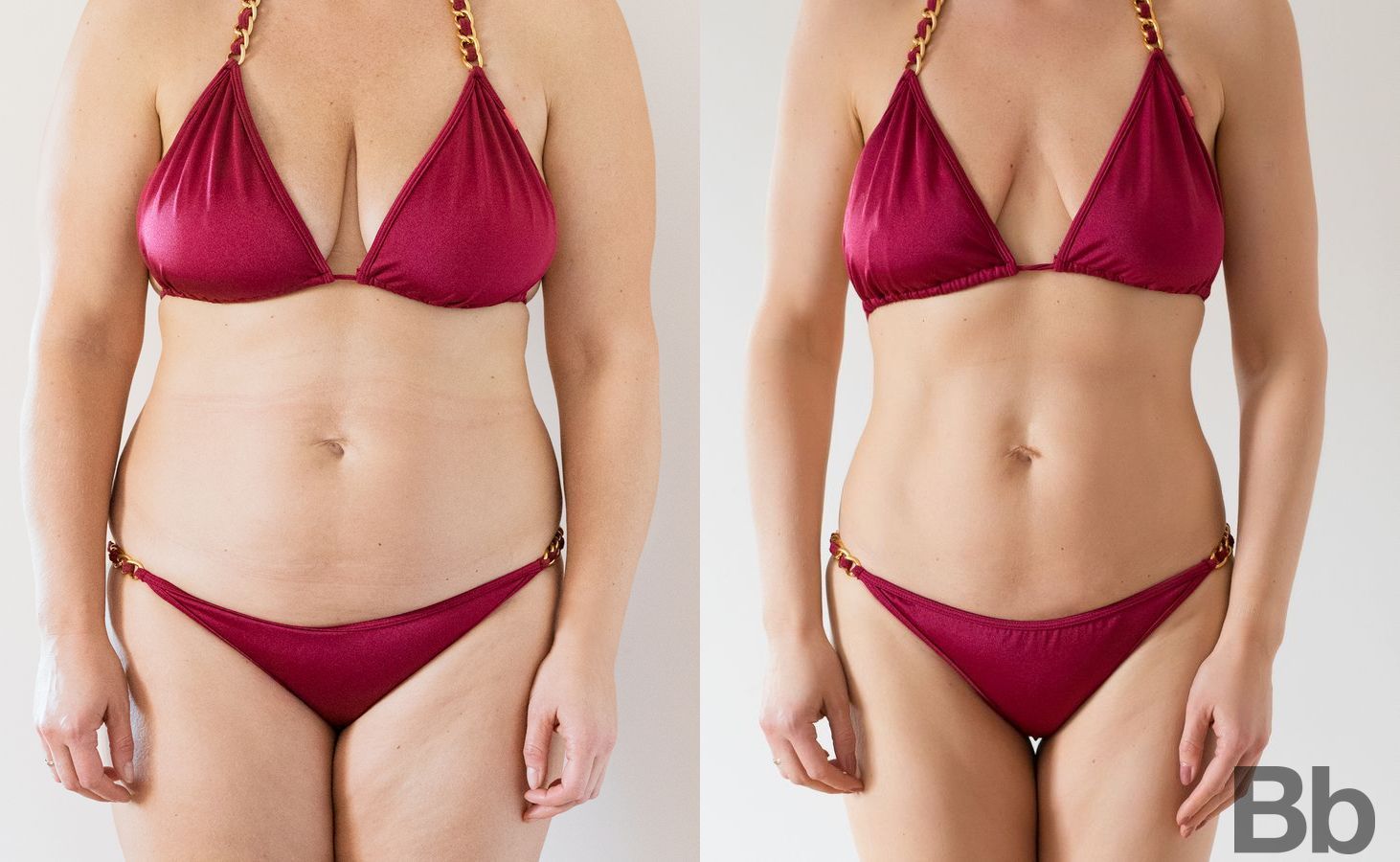 Before and after Liposuction case 23819