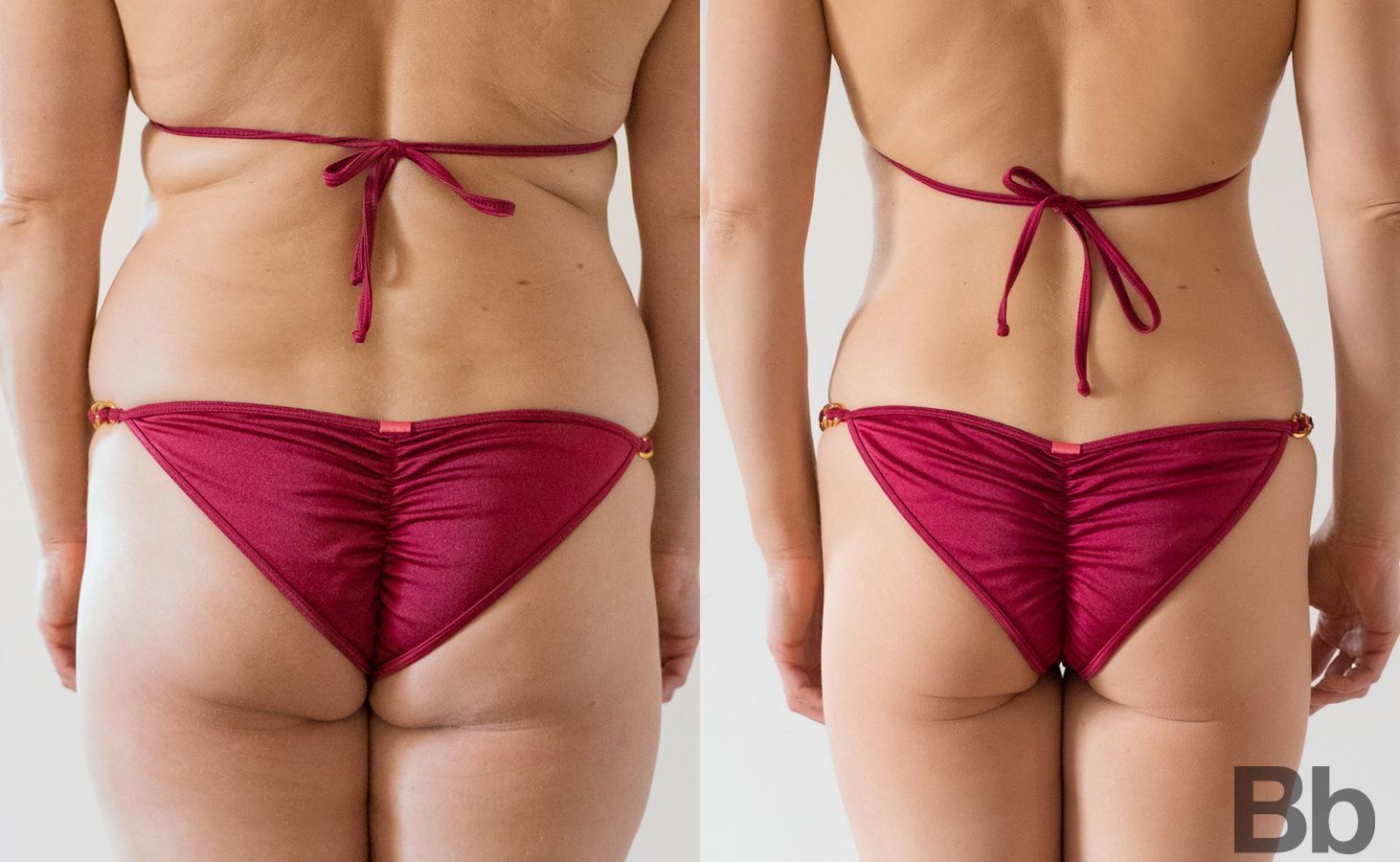 Before and after Liposuction case 23819 - Angle 3