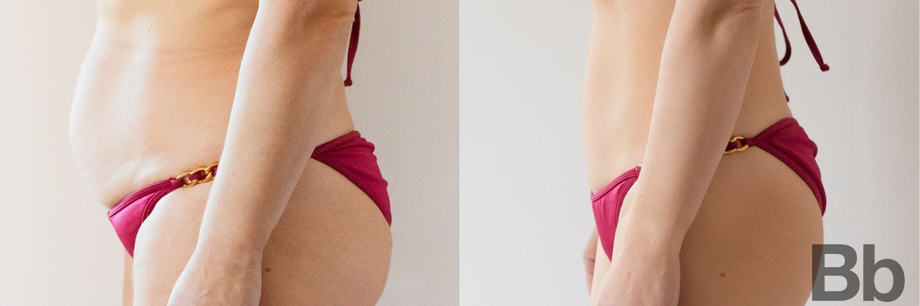 Before and after Liposuction case 23819 - Angle 2