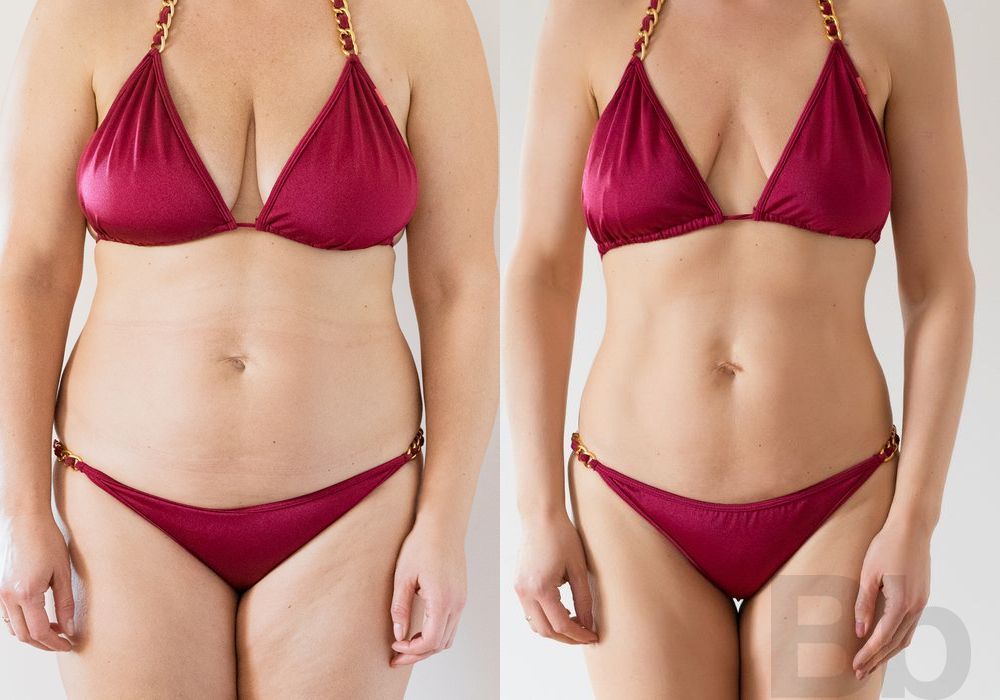 Liposuction - Case 32