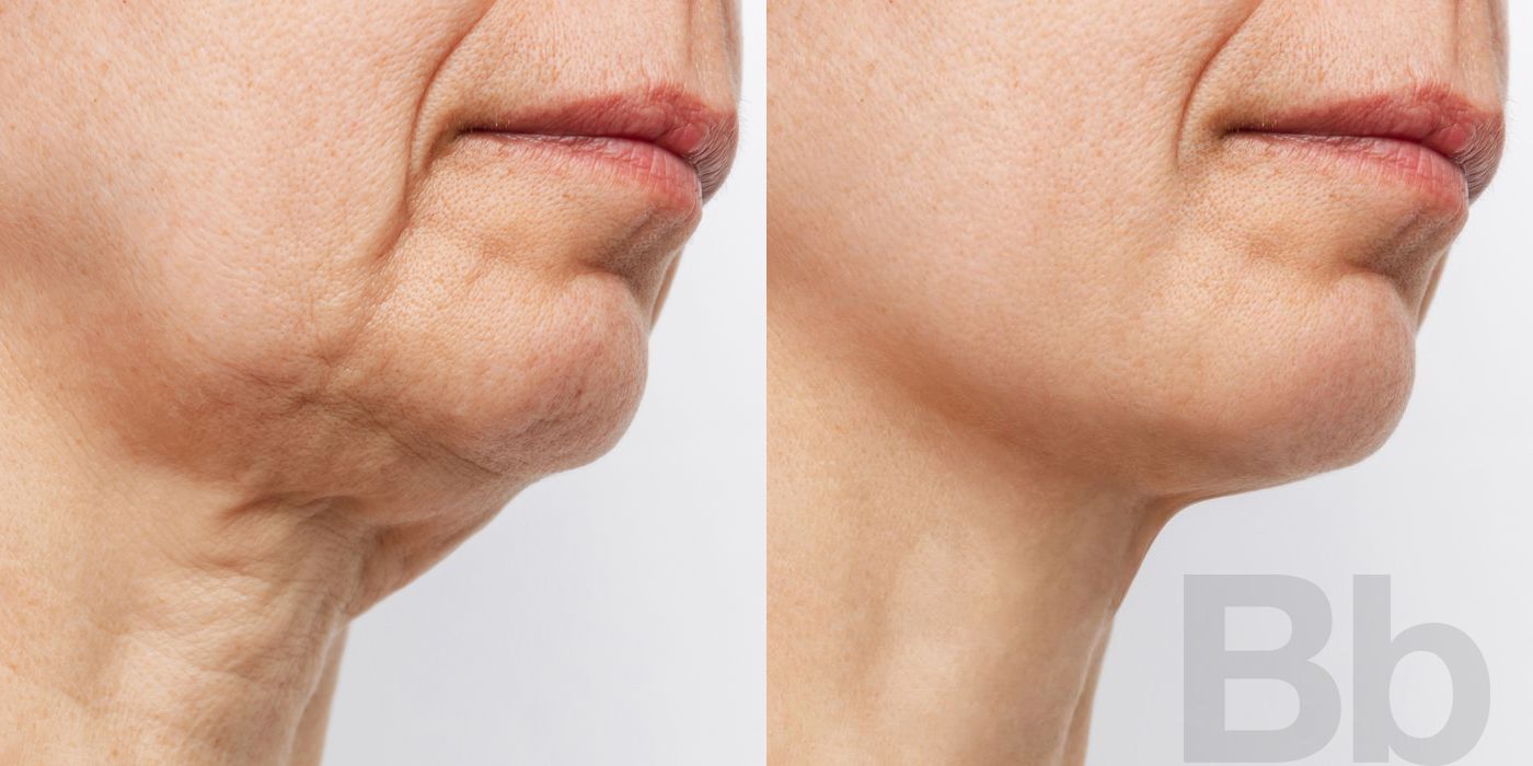 Morpheus 8 - Case 137