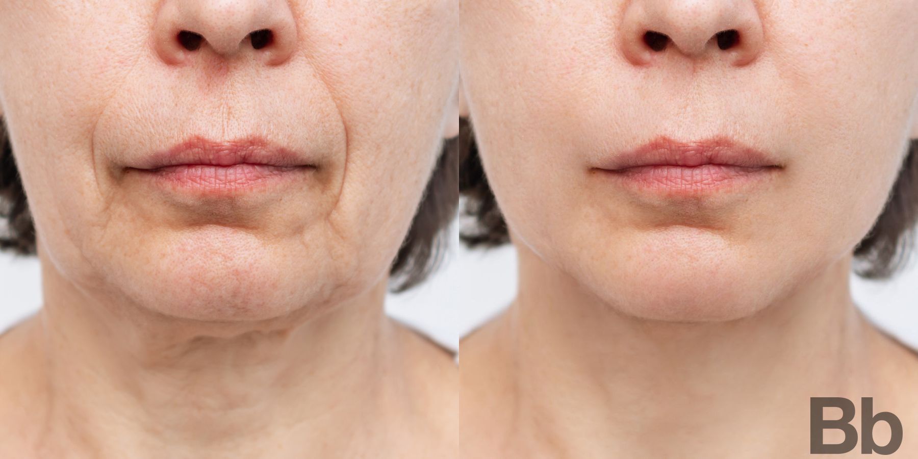 Before and after Morpheus 8 case 4758