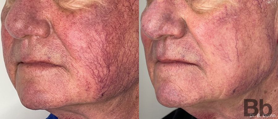Before and after Morpheus 8 case 19721