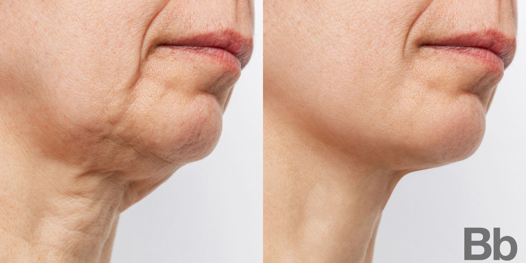 Before and after Morpheus 8 case 4757