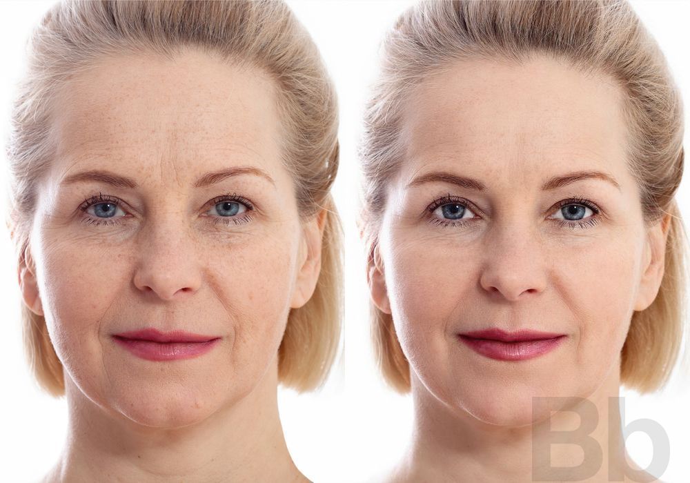 Morpheus 8 - Case 139