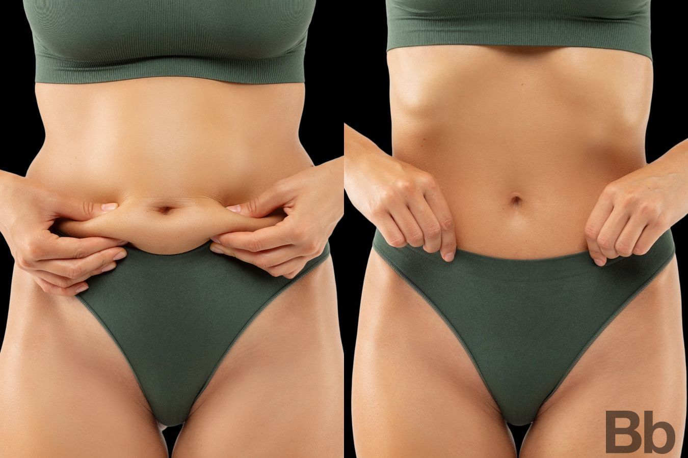 Before and after Liposuction case 4759