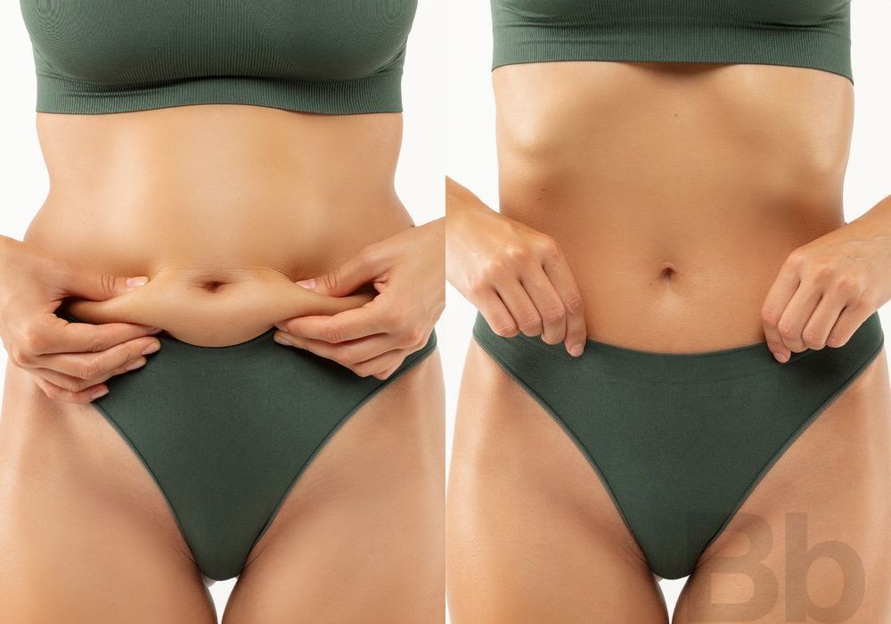 Liposuction - Case 21