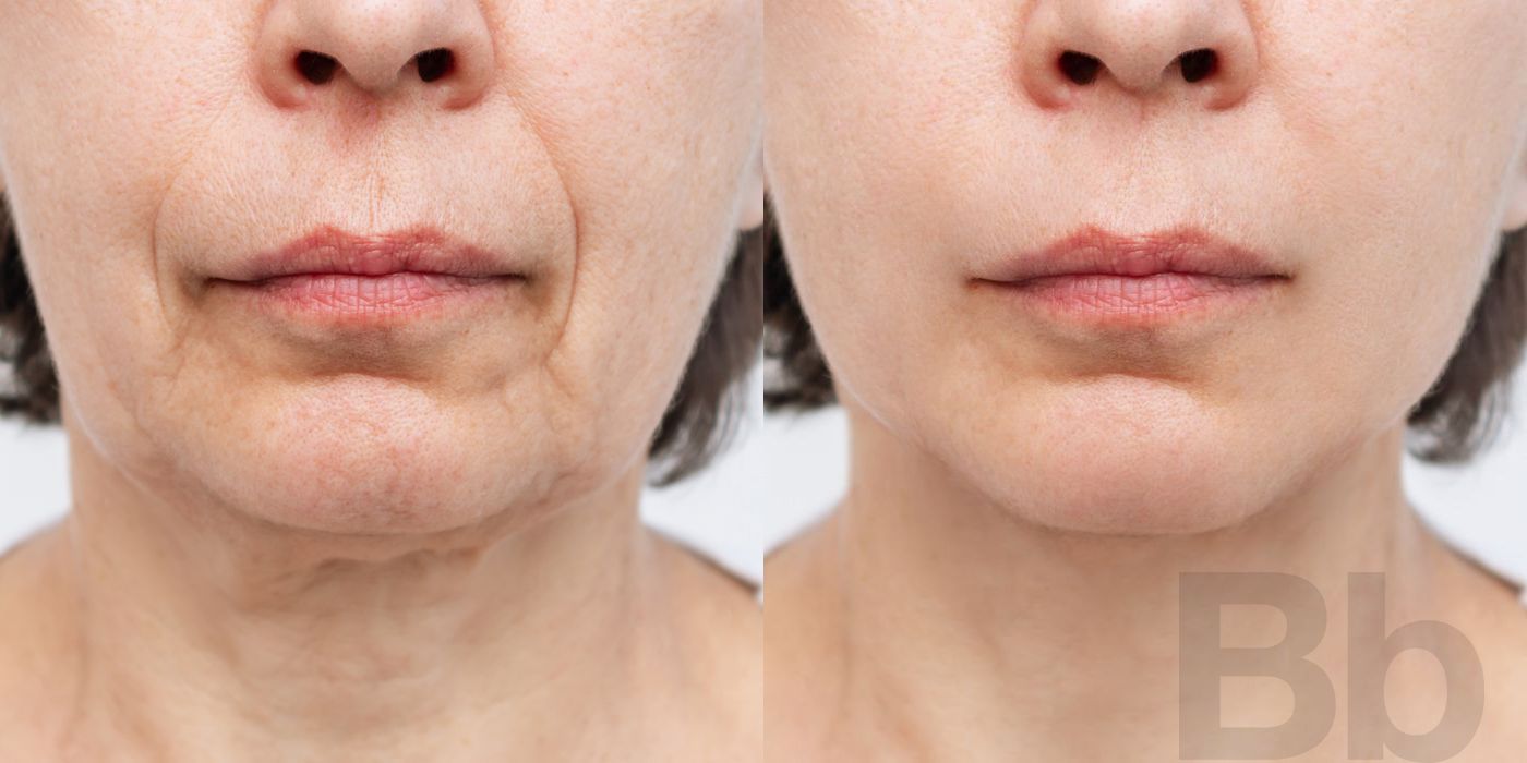 Non-surgical Skin Tightening - Case 140