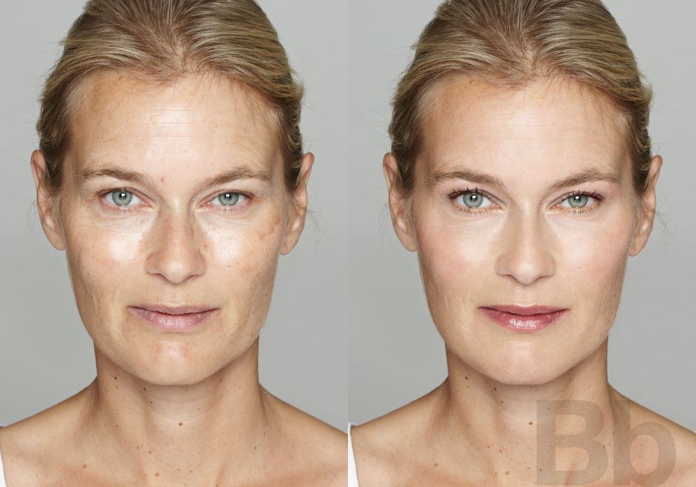 Peels & Facials - Case 141