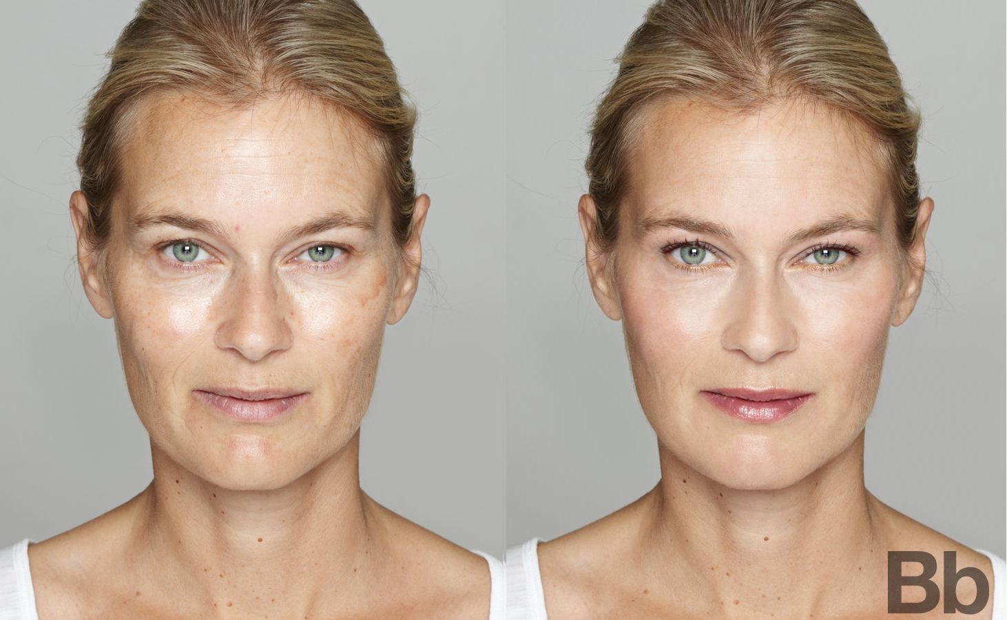Before and after Peels & Facials case 4779
