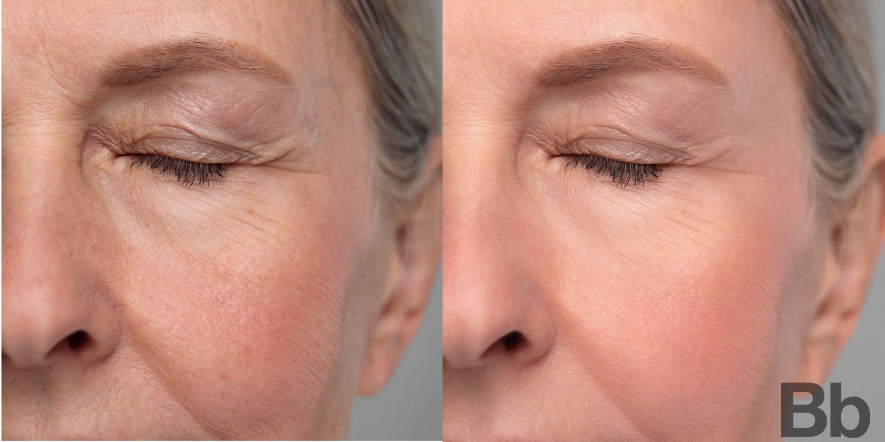 Before and after Photorejuvenation case 4769 - Angle 2