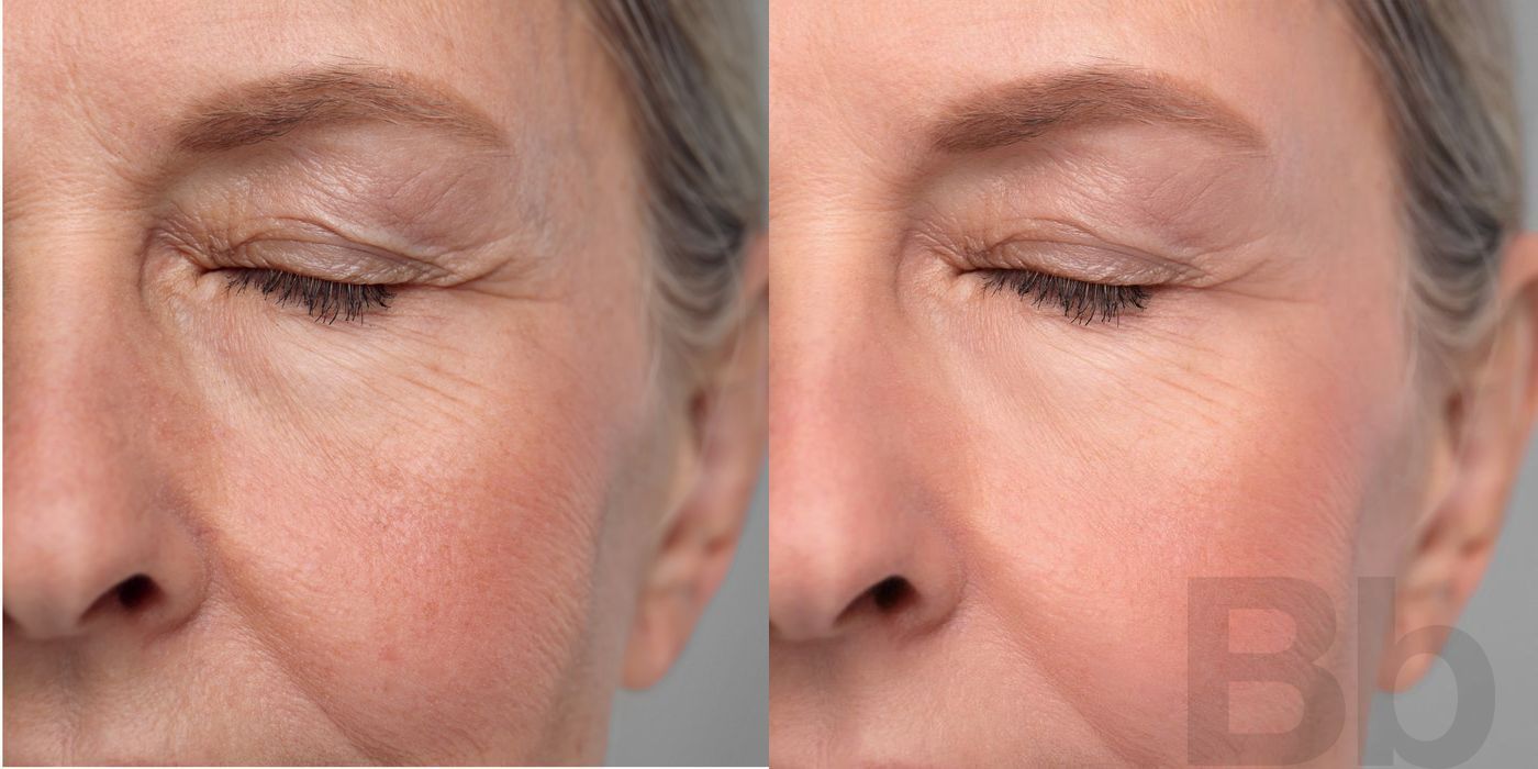 Photorejuvenation - Thumbnail 2