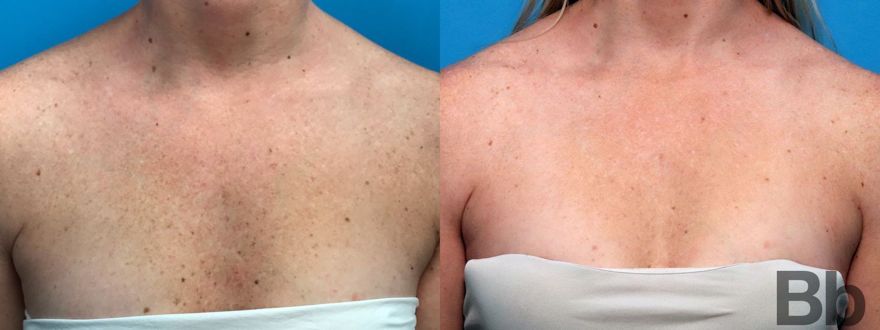 Before and after Photorejuvenation case 19717