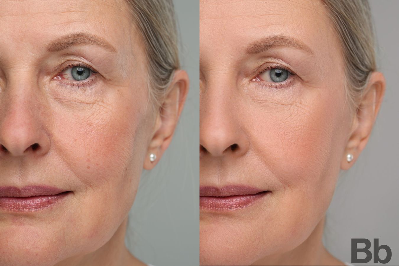 Before and after Photorejuvenation case 4769