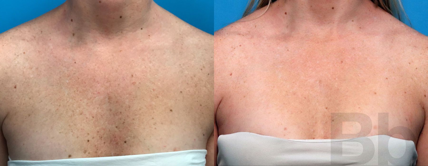 Photorejuvenation - Case 143