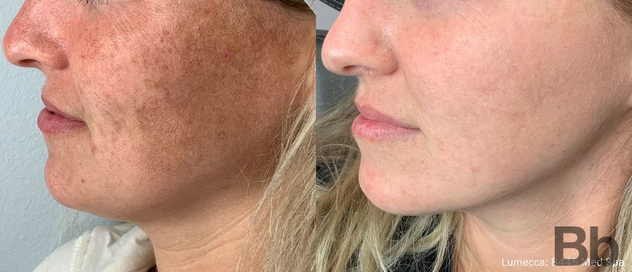 Before and after Photorejuvenation case 19720