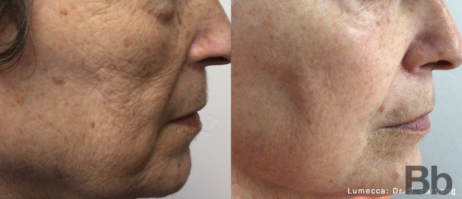 Before and after Photorejuvenation case 19725