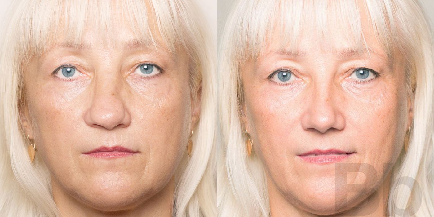 Rhinoplasty - Case 120