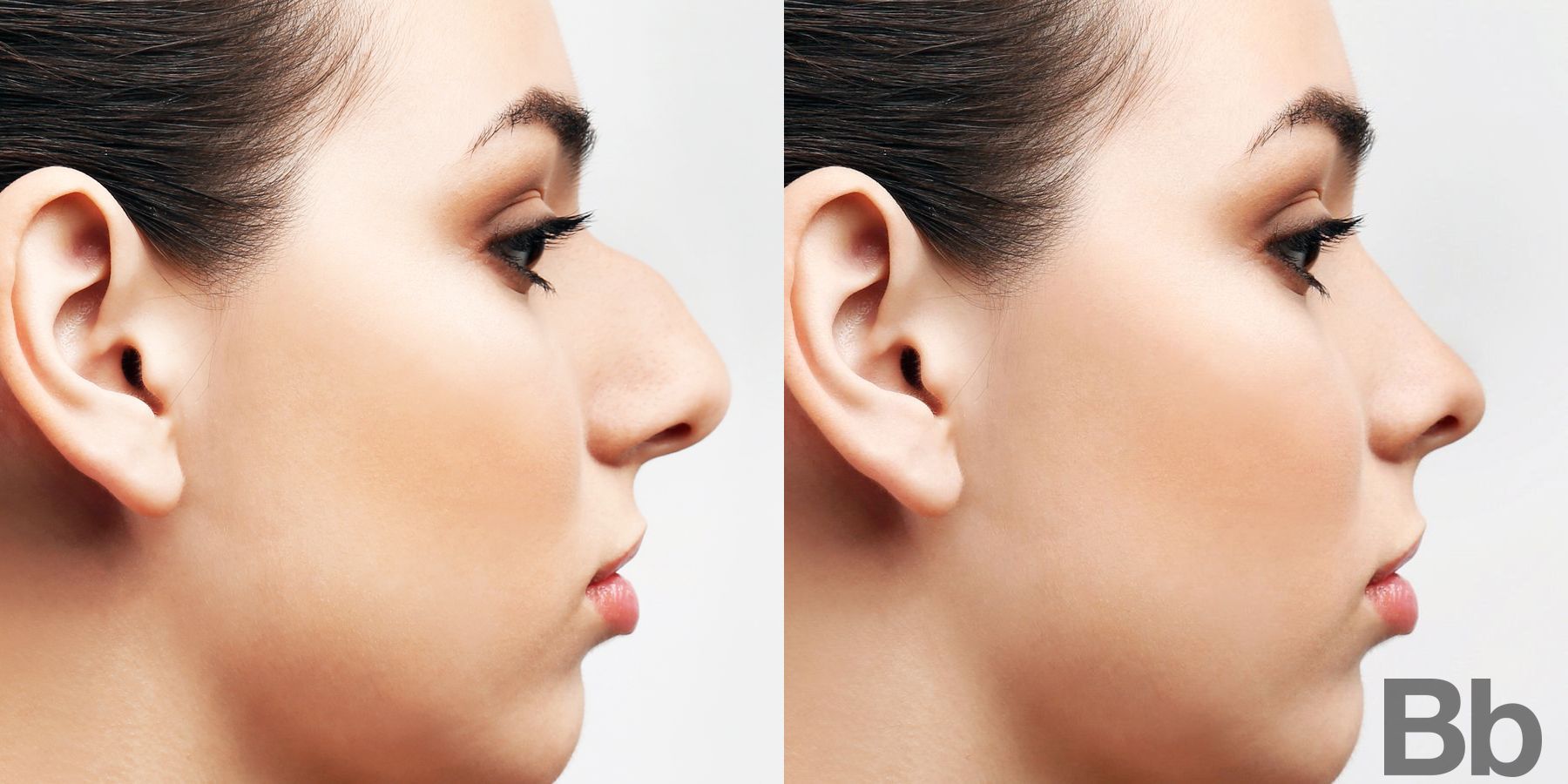 Before and after Rhinoplasty case 4747