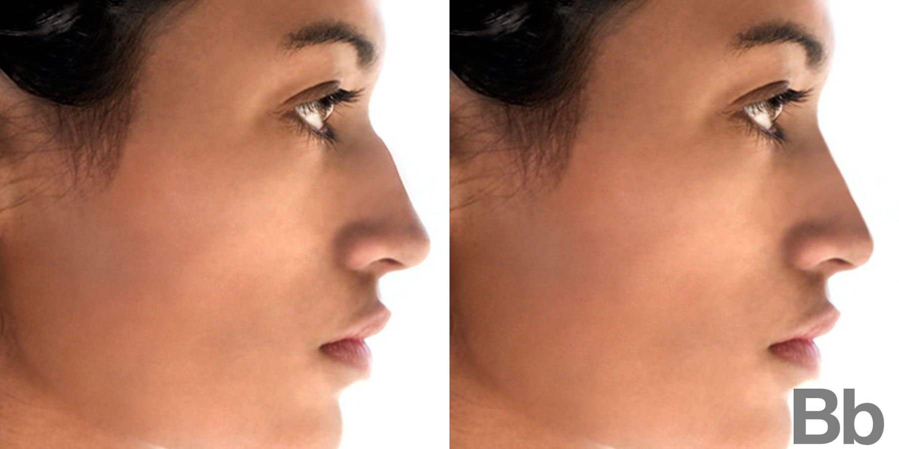 Before and after Rhinoplasty case 4746
