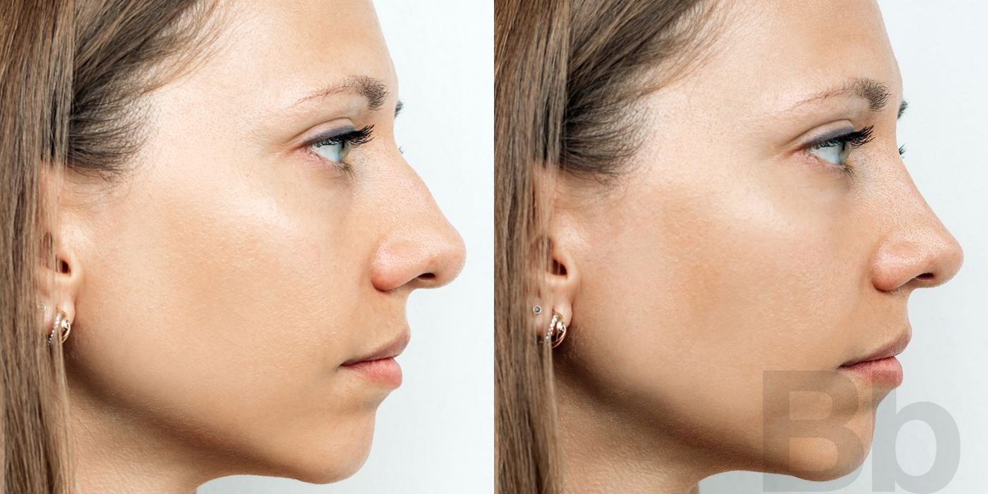 Rhinoplasty - Case 117