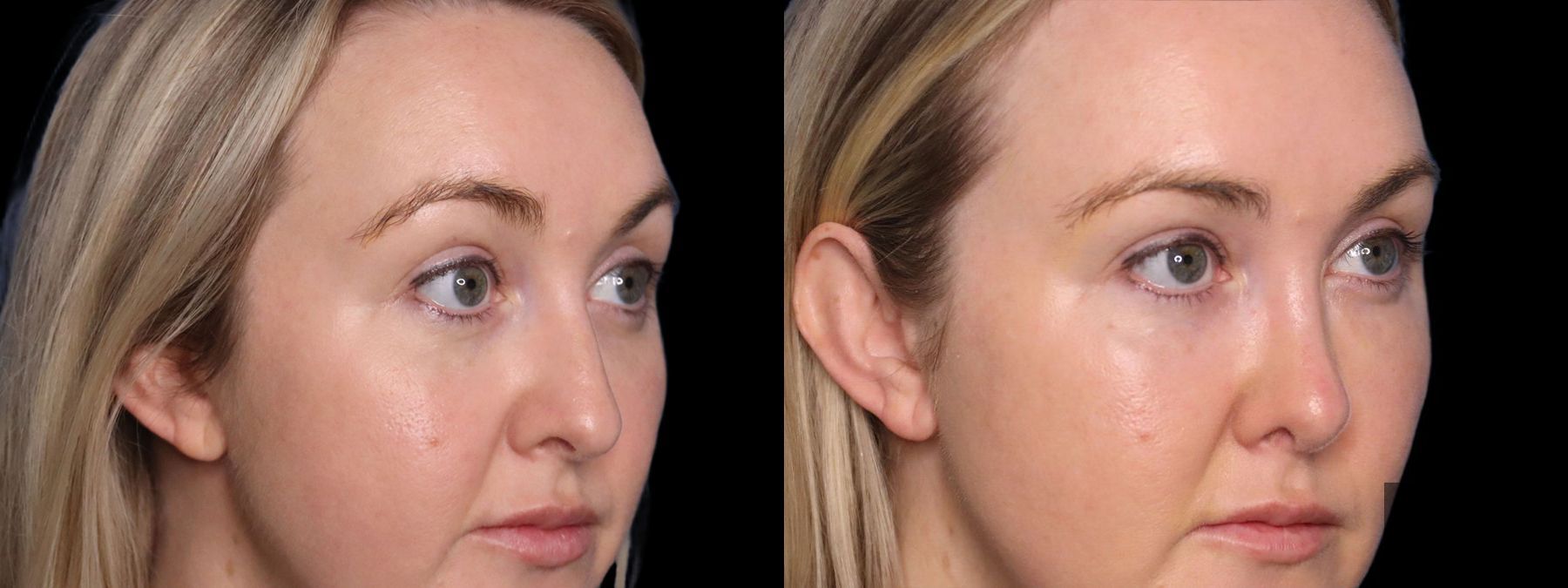 Before and after Facelift case 19715 - Angle 2