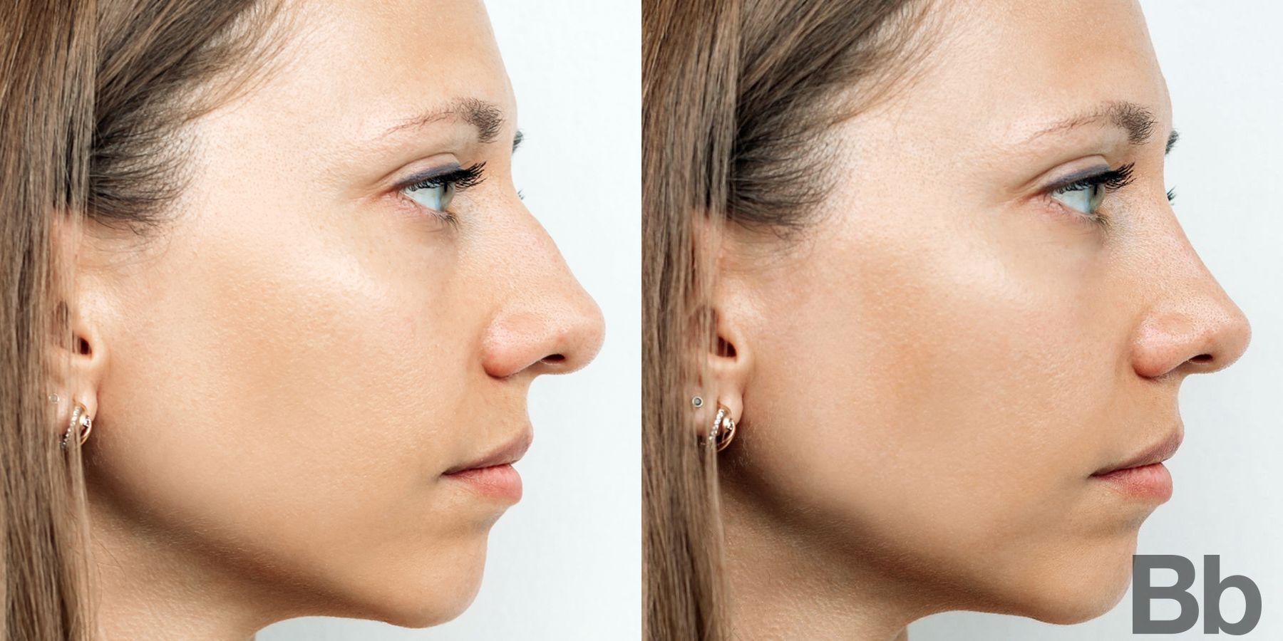 Before and after Rhinoplasty case 4745