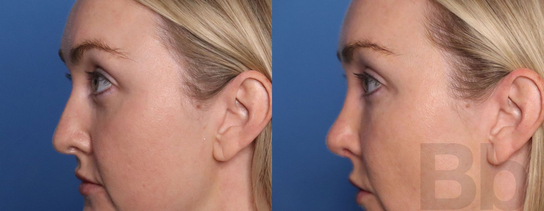 Facelift - Thumbnail 5