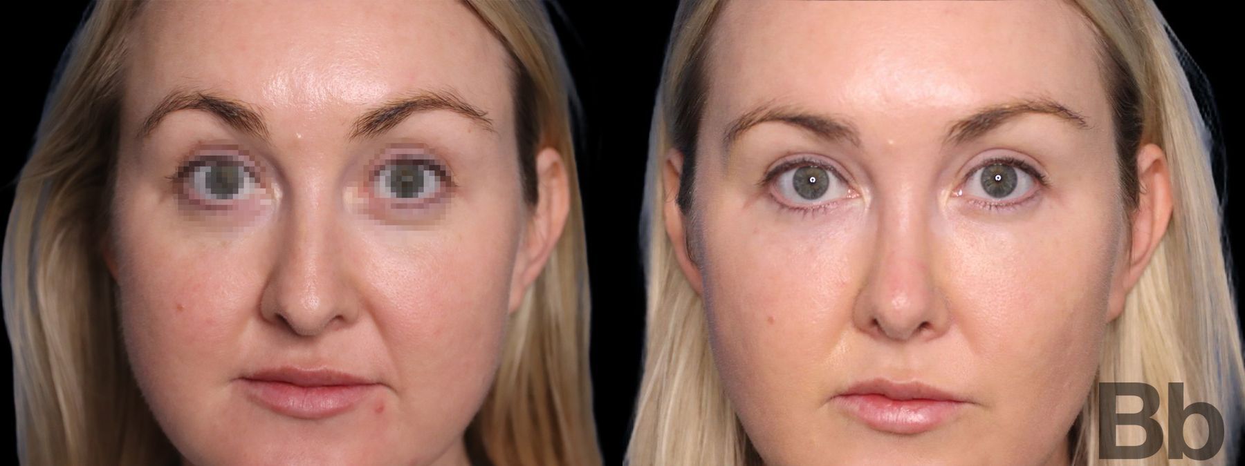 Before and after Facelift case 19715