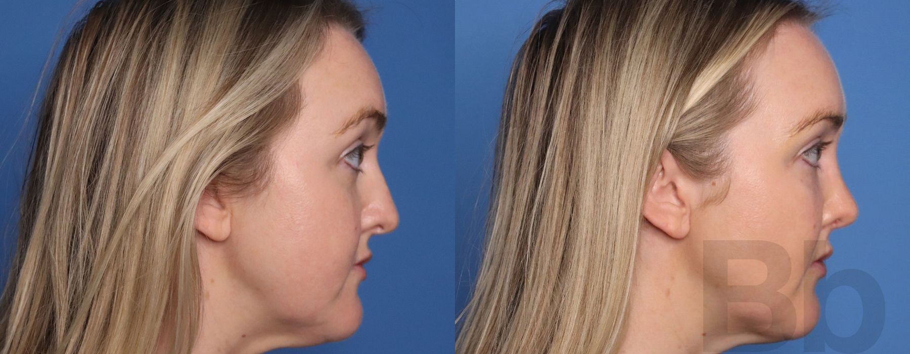 Facelift - Thumbnail 4