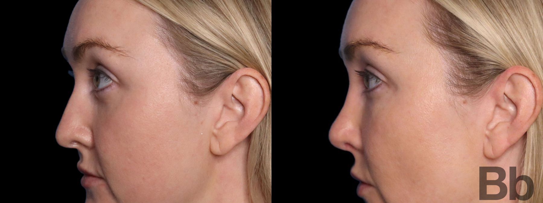 Before and after Facelift case 19715 - Angle 5