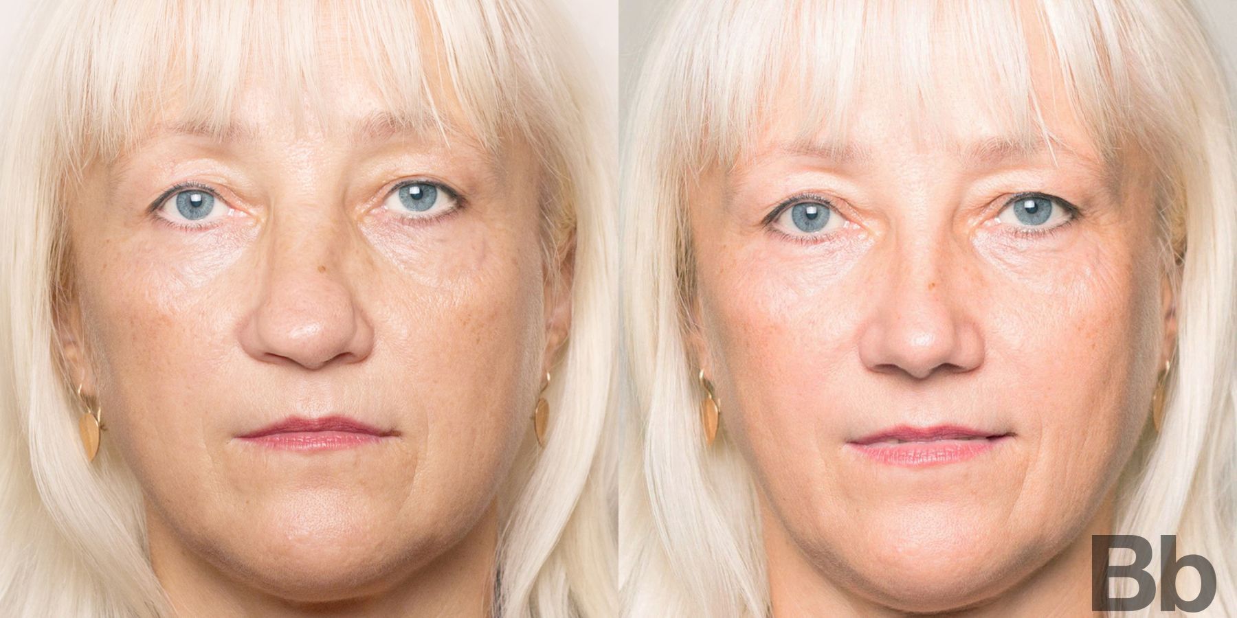 Before and after Rhinoplasty case 4748