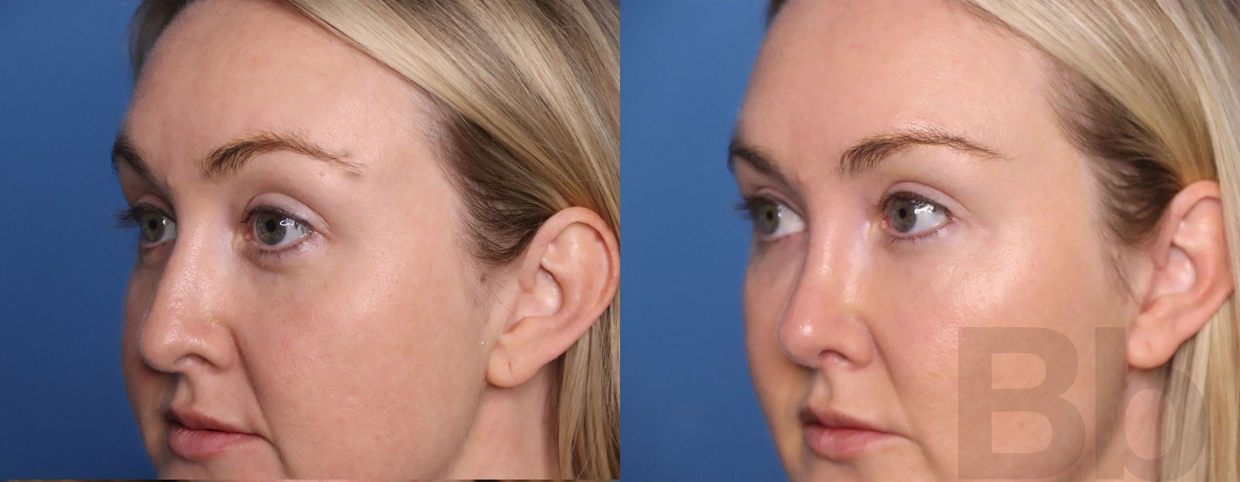 Facelift - Thumbnail 3