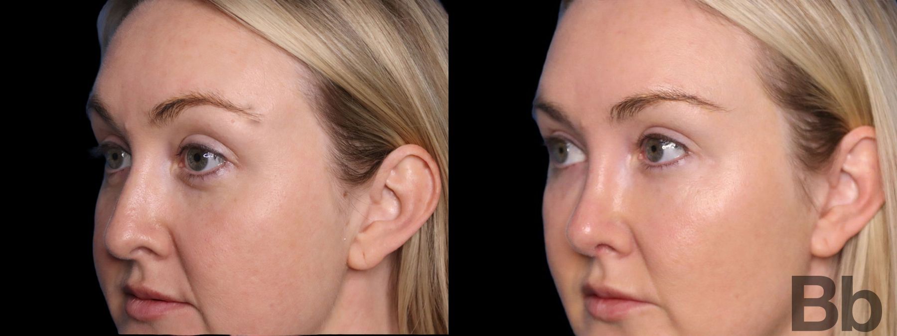 Before and after Facelift case 19715 - Angle 3