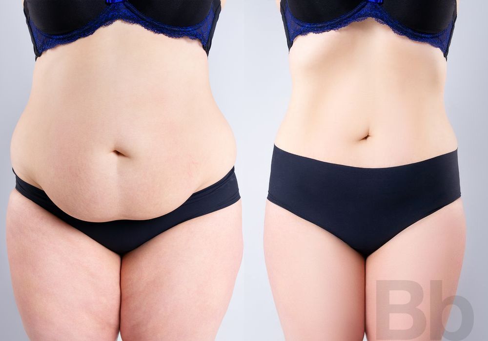 Liposuction - Case 27