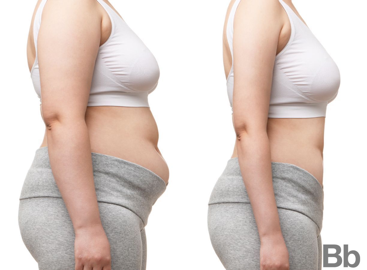 Before and after Tummy Tuck case 4799