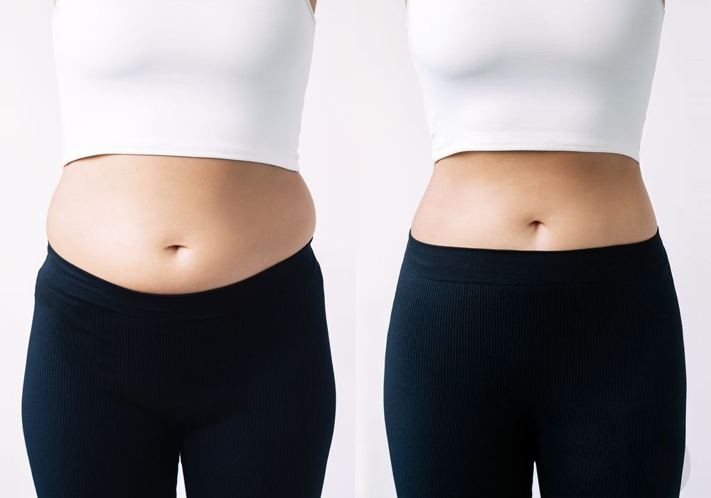 Liposuction - Case 29