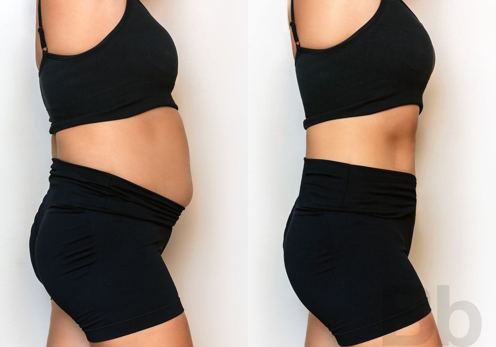 Liposuction - Case 1690