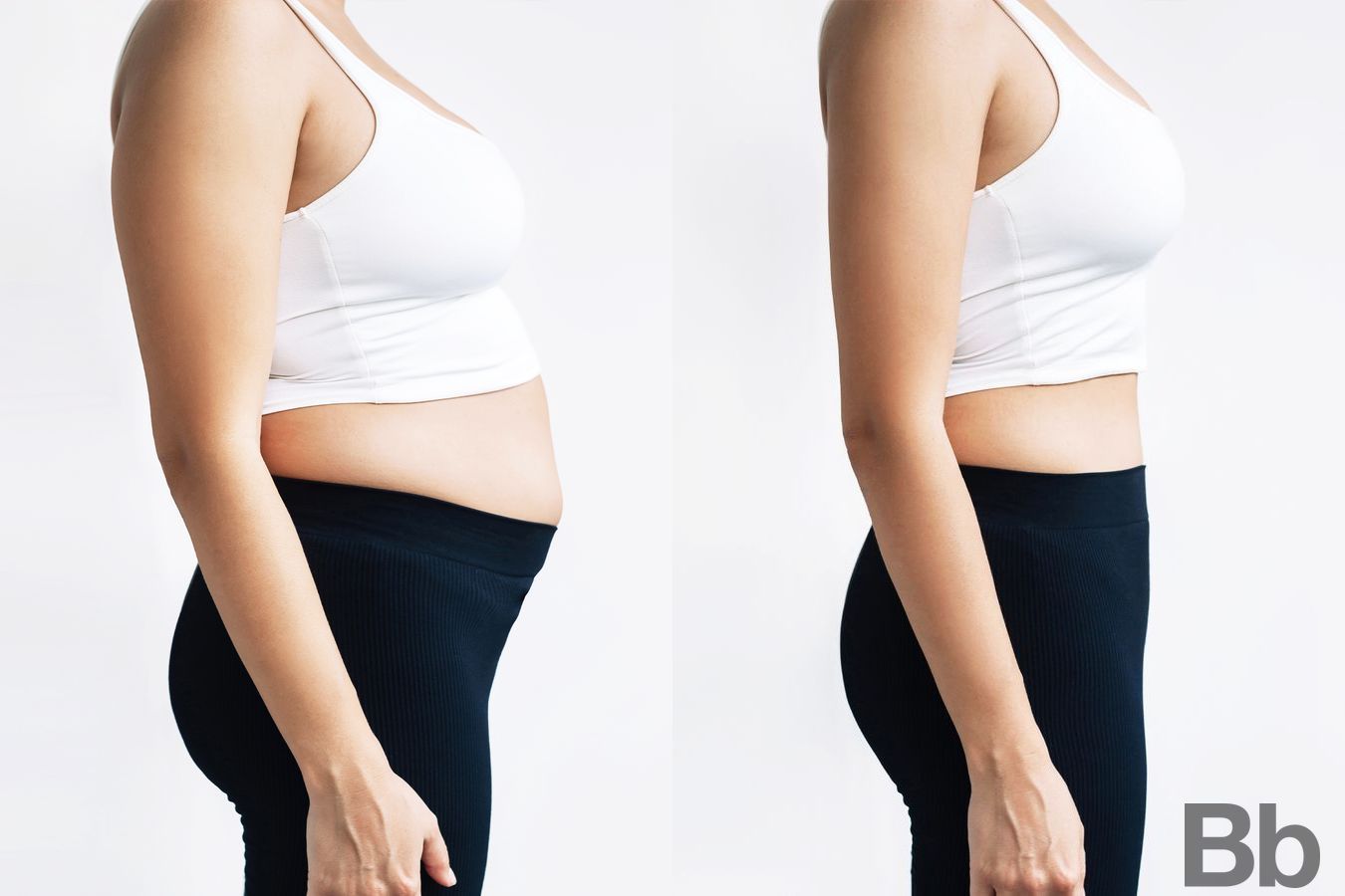 Before and after Liposuction case 4798 - Angle 2