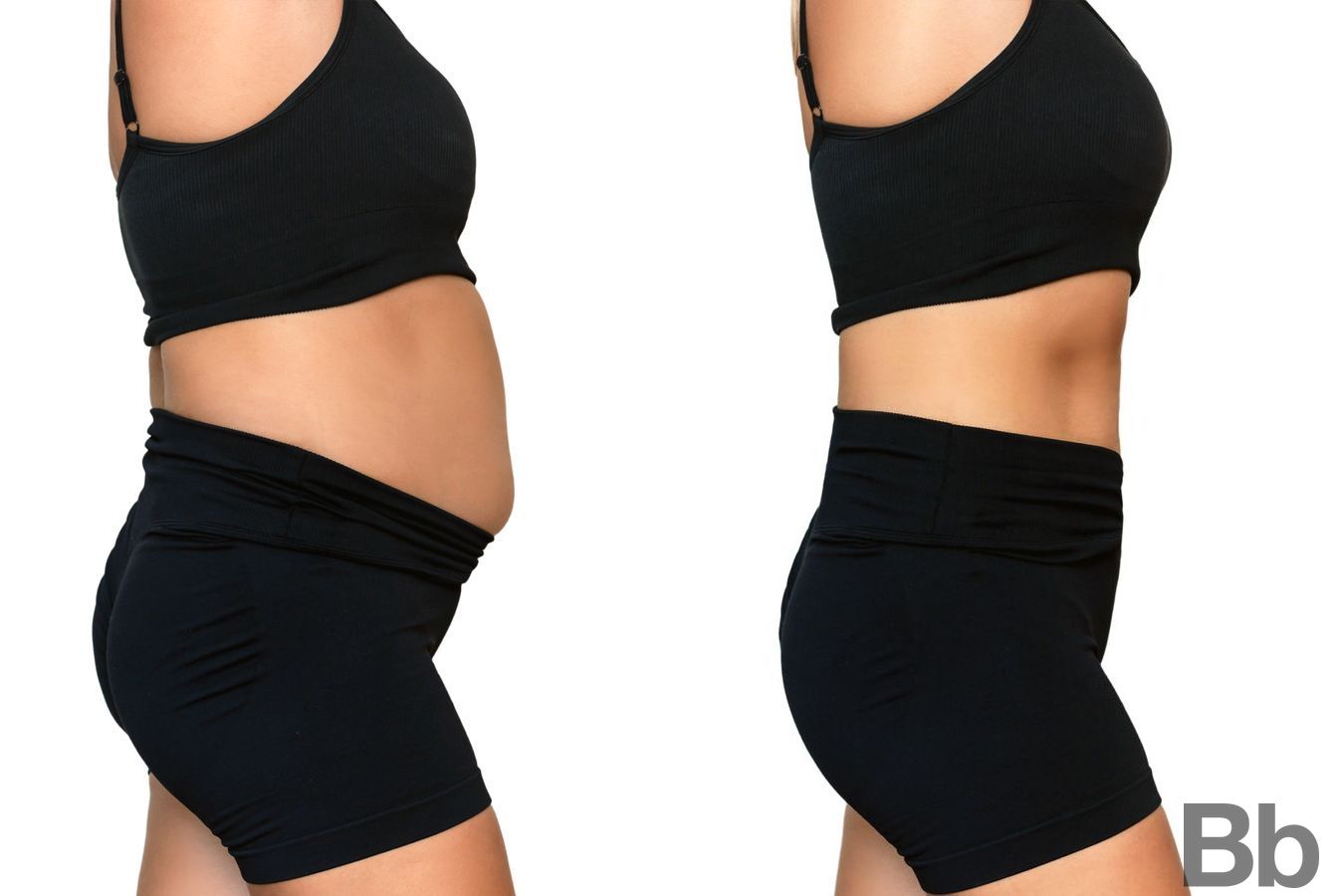 Before and after Liposuction case 4763