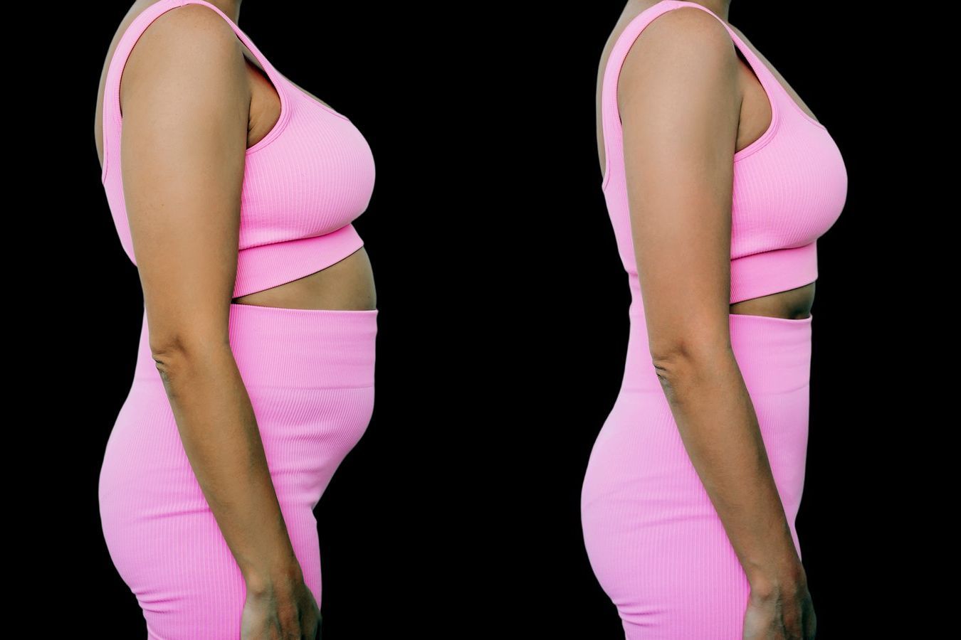 Before and after Liposuction case 4793