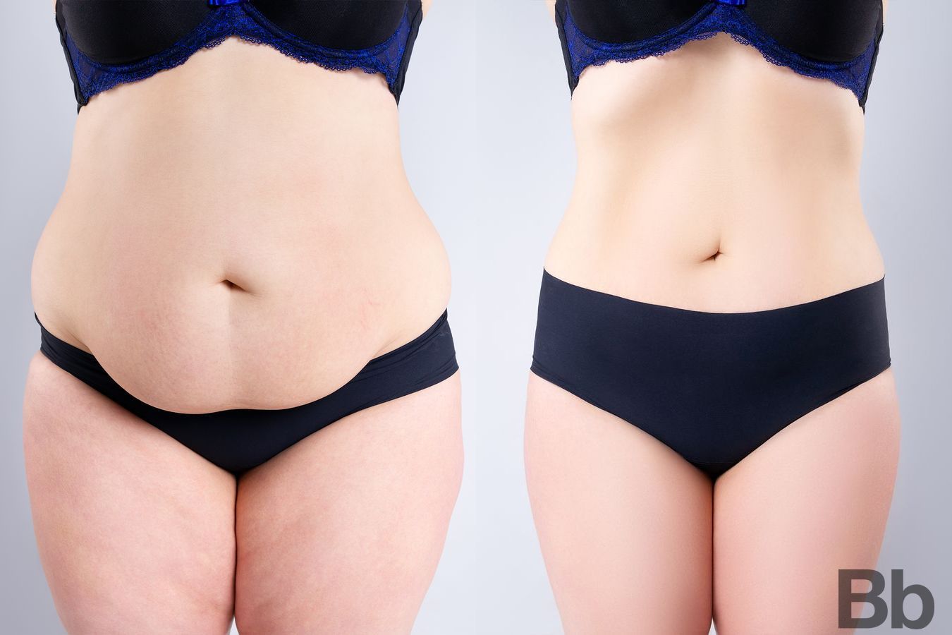 Before and after Liposuction case 4788