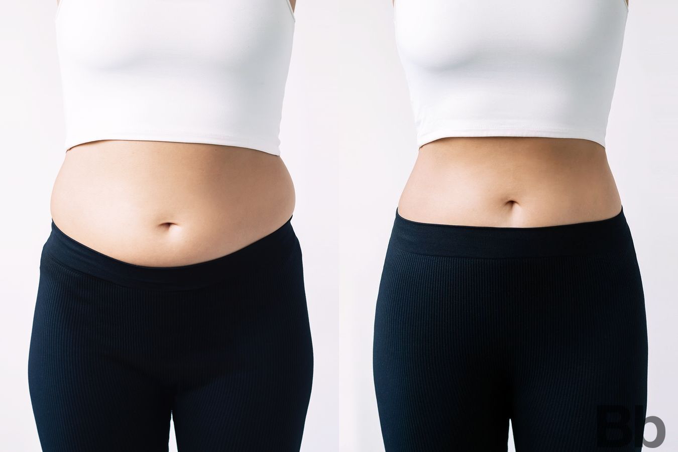 Before and after Liposuction case 4798
