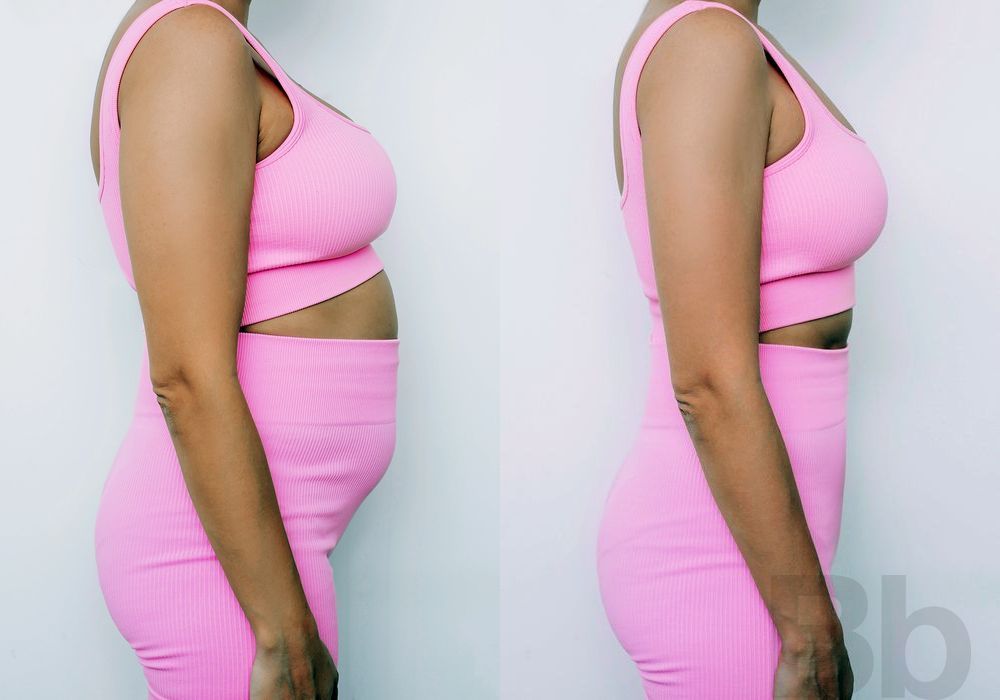 Liposuction - Case 28