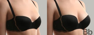 Before and after Breast Augmentation case 6983 - Angle 2
