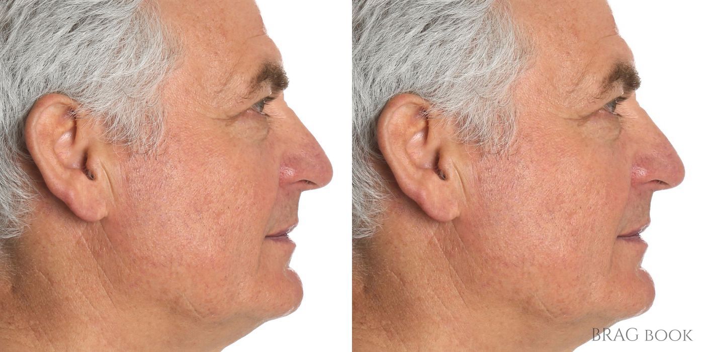 Top Surgery - Feminization - Thumbnail 4