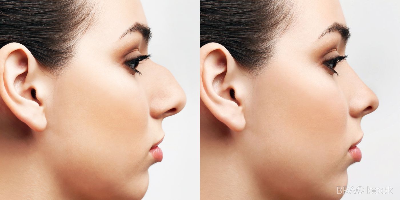 Before and after Rhinoplasty case 4747