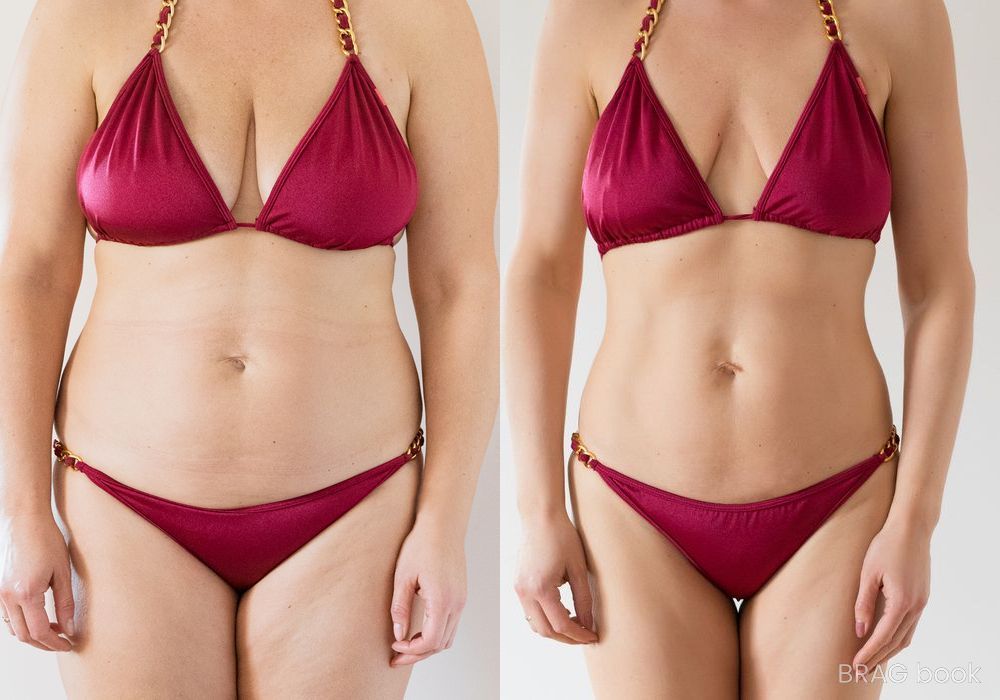 Before and after Liposuction case 4765 - Angle 2