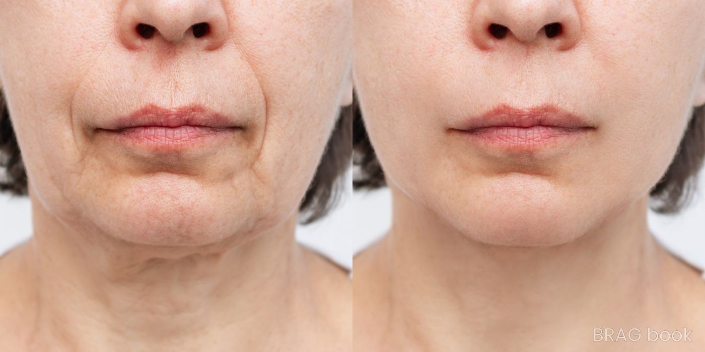 Before and after Non-surgical Skin Tightening case 4768